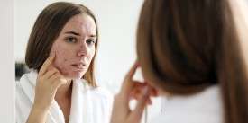 Connection Between Acne and Diabetes